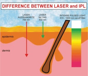 intense pulsed light laser treatments