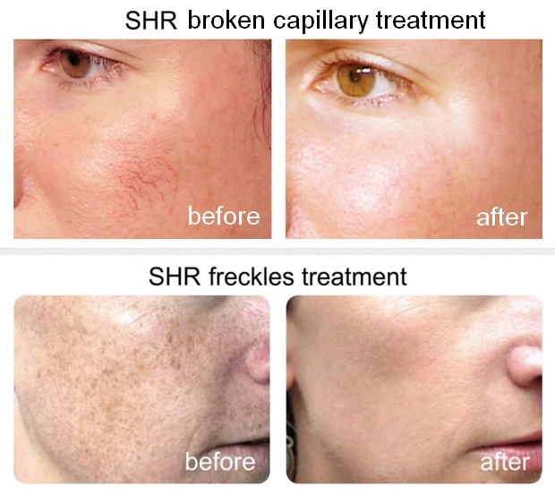 SHR Hair Removal and Skin Rejuvenation